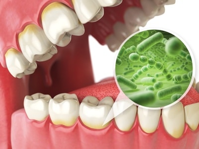 Zahnbelag und Zahnstein durch Bakterien